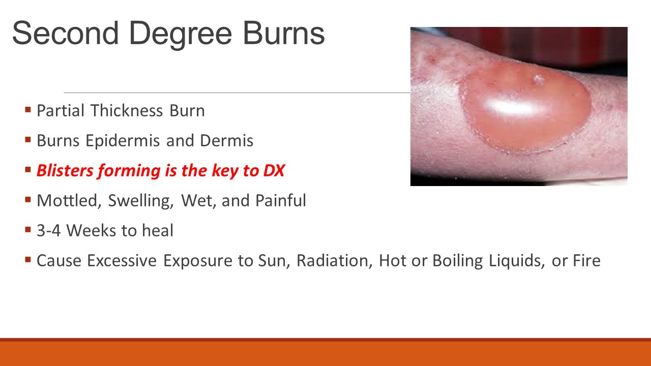3rd degree burn blister